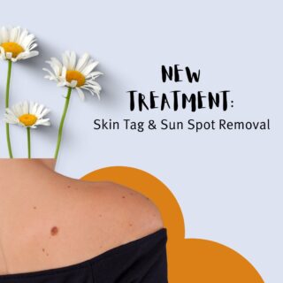 🌼NEW Hyfrecator Treatment available now! Schedule a consultation to find out how you can reduce the visibility of sun spots and remove minor skin growths - skin tags, moles, milia, warts, sebaceous hyperplasias, etc.⁠
⁠
✨LINK IN BIO✨ Hyfrecator Consultation⁠
*This appointment consists of the base price for treatment and may increase depending on the additional number of treatment areas and/or quantity of lesions*⁠